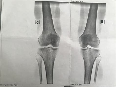Рентген - диагностика и лечение боли в коленном суставе